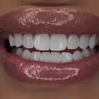 دندان مصنوعی تحویل ۵ ساعته، کامپوزیت دندان