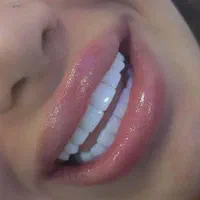 کامپوزیت دندان (( طرح لبخند ))