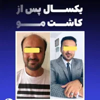 کاشت مو بدون جراحی یک روزه ضمانت مادام العمر|خدمات آرایشگری و زیبایی|تهران, ونک|دیوار