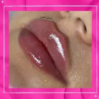 تخفیفات30درصدی ژل و بوتاکس وفیلر دکتر زیبایی