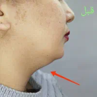 لیفت وجوانسازی قوی صورت|خدمات آرایشگری و زیبایی|رشت, گلسار|دیوار