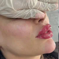 تخفیف ویژه چال لپ ، فیلر بادی ، بوتاکس ، جوانسازی