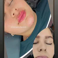 آموزش فیلر چونه بوتاکس ژل لب مزوژل پرسینگ|خدمات آرایشگری و زیبایی|مشهد, موسوی قوچانی|دیوار