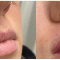 ژل لب،فیلر بوتاکس لیزر موهای زاید درمجموعه پزشکی|خدمات زیبایی و سلامت|تهران, پرستار|دیوار