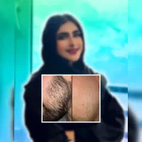 رویش مجدد ریش