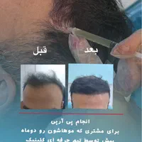 کاشت مو و ابرو با پترو و آزاد