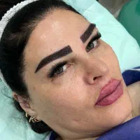 کاشت تخصصی ابرو توسط تکنسین درمان