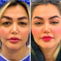 بلفاروپلاستی توسط متخصص چشم با بخیه سوپرنانو لیزری