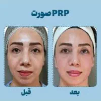 پی آر پی مو و صورت  فقط ۱۱۰۰|خدمات آرایشگری و زیبایی|محمدیه-قزوین, |دیوار