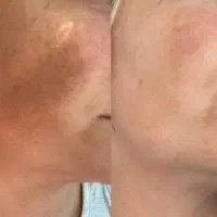 درمان قطعی لک و روشن سازی بدن