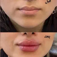 درمانی ژل صورت