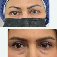 بلفاروپلاستی چشم گربه ای ارومیه