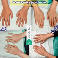 تزریق فیلر بادی ،ساکشن، تزریق چربی صورت و بدن|خدمات آرایشگری و زیبایی|صدرا-فارس, |دیوار