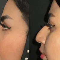 عمل بینی|خدمات آرایشگری و زیبایی|اهواز, نادری|دیوار