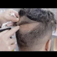 خدمات پروتز مو