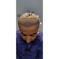کاشت شیرازی موی سر و ابرو در ارومیه به مدت کوتاه|خدمات آرایشگری و زیبایی|ارومیه, |دیوار