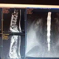 راهنمای فتق دیسک