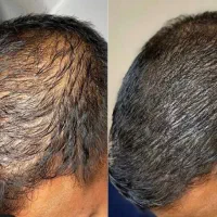 مزوی مو ۱ تومن،جوانسازی صورت ۱ ،زاویه ۲و ساکشن