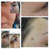برداشتن خال زگیل و میخچه با محلول صدر صد گیاهی|آرایشی، بهداشتی، درمانی|کرمان, |دیوار