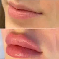 مدل فیلر بوتاکس انزیم مزو تراپی