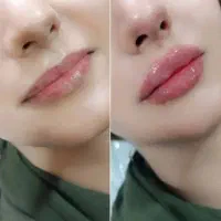 تزریق تخصصی فیلر، بوتاکس، ژل ، مطب زیبایی