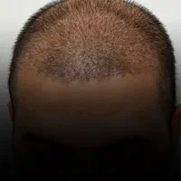 کاشت ابرو و مو با تیم تخصصی در کلینیک معتبر|خدمات آرایشگری و زیبایی|رشت, بوسار|دیوار