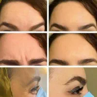 جشنواره تزریق ژل بوتاکس فیلر پی آرپی مطب زیبایی|خدمات آرایشگری و زیبایی|تبریز, |دیوار