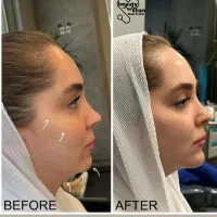 خدمات زیبایی  ساکشن و تزریق فیلر های بادی
