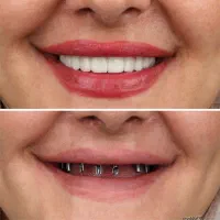 دندانپزشکی ایمپلنت دیجیتال و فوری روکش اوردنچر و..|خدمات آرایشگری و زیبایی|تبریز, |دیوار