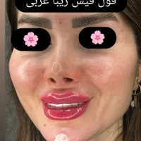 فیلر لب.بوتاکس.مزوژل.لب روسی.|خدمات آرایشگری و زیبایی|بندر انزلی, چهارفریضه|دیوار