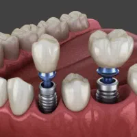 ایمپلنت قسطی