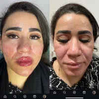 کانتورینگ کامل صورت پرداخت در سه قسط
