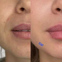 تزریق وآموزش ژل وبوتاکس  ۲۵۰۰ درکلینیک|خدمات آرایشگری و زیبایی|اهواز, بیست متری شهدا|دیوار