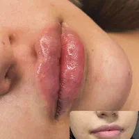 ژل لب تزریق ژل بوتاکس ژل گونه چانه زاویه فک|خدمات آرایشگری و زیبایی|اصفهان, سعادت‌آباد|دیوار