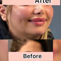 تخفیف۵۰درصد.بوتاکس۸۰۰ژل۹۰۰مزومزوژلprp پزشک