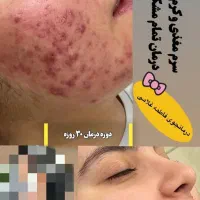 درمان جوش با بهترین روش و محصول|آرایشی، بهداشتی، درمانی|اهواز, ۲۰۰۰واحدی|دیوار