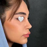 عمل جراحی بینی توسط متخصص زیباییent/ترمیم بینی|خدمات آرایشگری و زیبایی|کرج, چهارصد دستگاه|دیوار