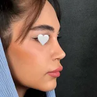 عمل جراحی بینی توسط متخصص زیباییent/ترمیم بینی|خدمات آرایشگری و زیبایی|کرج, چهارصد دستگاه|دیوار