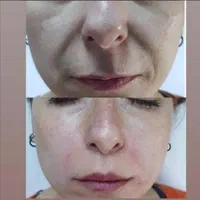 تزریقات و خدمات زیبایی کلینیک بوتاکس ژل مزو PRP|خدمات آرایشگری و زیبایی|کرمانشاه, |دیوار