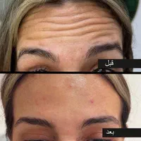 تزریق مزوژل روشن‌کننده جوانساز وبوتاکس|خدمات آرایشگری و زیبایی|آبادان, |دیوار