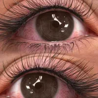 مدل برای فیبروز ابرو