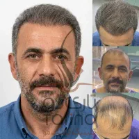 کلینیک کاشت مو بیمارستان ارتش همدان (تضمینی)