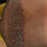کاشت مو|خدمات آرایشگری و زیبایی|یاسوج, |دیوار