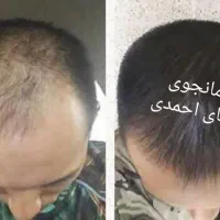 پک رشد مو با ضمانت نامه کتبی بازگشت پول 120 درصدی