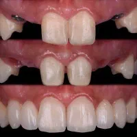 شرایط اقساطی خدمات دندانپزشکی ایمپلنت،ارتودنسی،|خدمات آرایشگری و زیبایی|جلفا, |دیوار