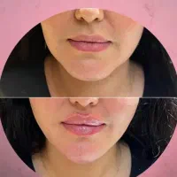 تخفیف تزریق ژل وبوتاکس|خدمات آرایشگری و زیبایی|آمل, |دیوار