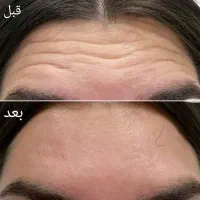 تزریق بوتاکس توسط پزشک ۷۸۰ت|خدمات آرایشگری و زیبایی|شیراز, کوی وحدت|دیوار