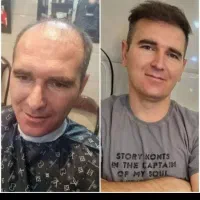 کلینیک کاشت مو و ابرو در تبریز