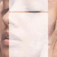 آموزش تزریق بوتاکس مقدماتی و پیشرفته