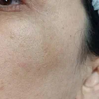 درمان تخصصی لک و فیشال کلینیک تخصصی کمیل|خدمات آرایشگری و زیبایی|اهواز, زیتون کارمندی|دیوار